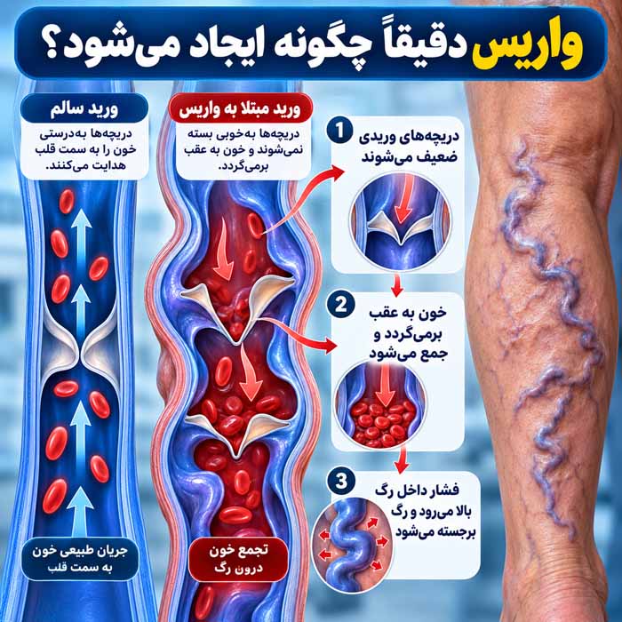 دلیل ایجاد واریس چیست؟ علتهای اصلی، عوامل خطر و نشانههایی که نباید نادیده گرفت واریس دقیقاً چگونه ایجاد میشود؟