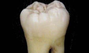 قبل از خواب دندانها را تمیز کنید خرابی دندان,سلامت دندان