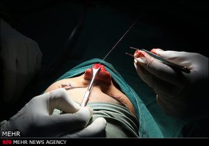 عکسهایی از نحوه عمل جراحی زیبایی بینی +16