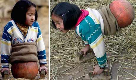 داستان زندگی دختری با بدن نصفه! +عکس