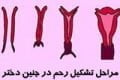 راه تشخیص دو رحم بودن زنان و درمانش تشکیل رحم دختران
