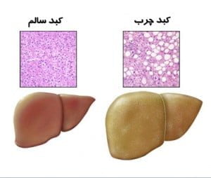 دو نوشیدنی مفید بر علیه کبد چرب درمان کبد چرب, نوشیدنی برای کبد چرب