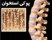 6 عامل پوکی استخوان