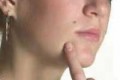 خال هایی را که نباید لیزر کرد
