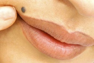 اطلاعات در مورد انواع خال پوستی + خال خوش خیم و بدخیم چگونه هستند خال خوش خیم و بدخیم چگونه است؟