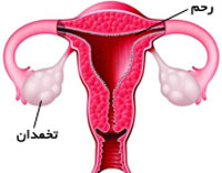 علائم هشداردهنده سرطان تخمدان