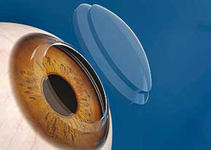 چه زمانی پیوند قرنیه انجام می شود؟