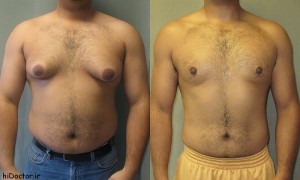 دلیل ژنیکوماستی (بزرگی سینه مردان) چیست؟ علل و درمان ژنیکوماستی
