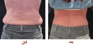 کرایولیپولیز روش برای از بین بردن چربی اضافه