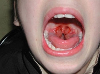 بیماری خناق یا دیفتری چیست؟