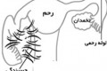 مشکل چسبندگی رحم و نازایی مشکل چسبندگی رحم و نازایی