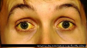 زردی یا یرقان چیست؟ درمان یرقان زردی یا یرقان چیست؟ درمان یرقان