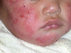نحوه درمان اگزما + علائم، دلایل و درمان خانگی اگزما نحوه درمان اگزما + علائم، دلایل و درمان خانگی اگزما