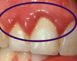 بیماری لثه, علائم و درمان بیماری های لثه بیماری لثه