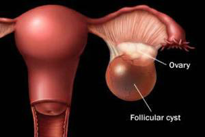 کیست تخمدان، علائم کیست تخمدان و درمان