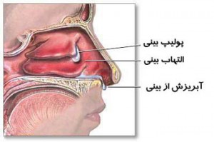 دلیل گرفتگی بینی چیست؟ گرفتگی بینی