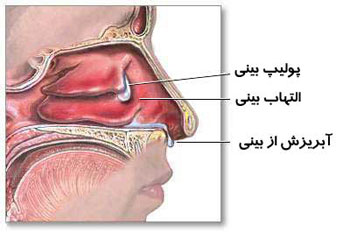 دلیل گرفتگی بینی چیست؟