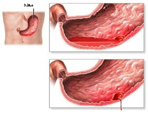 نحوه تشخیص خونریزی گوارشی