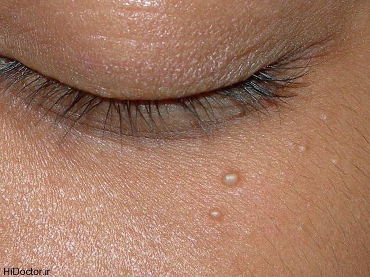 دلیل وجود دانه های سفید زیر چشم چیست؟