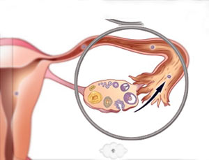 مشکل تنبل شدن تخمدان و کم کاری تخمدان
