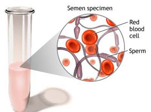 مشکل مشاهده خون در مایع منی