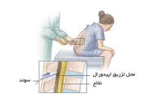 تسکین درد زایمان با بی حسی اپیدورال تسکین درد زایمان با بی حسی اپیدورال