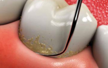 لق شدن دندان با جرم گیری