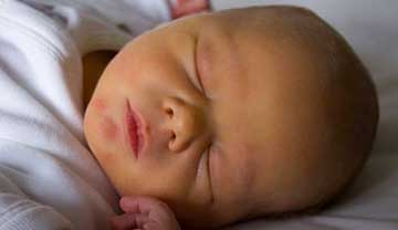 دلیل بروز زردی در نوزاد