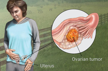 سرطان تخمدان اطلاعاتی در مورد سرطان تخمدان