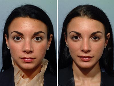 آیا جراحی زیبایی بینی را برای دوم می توان انجام داد؟