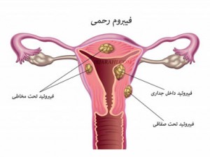 احتمال نازایی و سرطان به دلیل فیبروم رحمی احتمال نازایی و سرطان به دلیل فیبروم رحمی