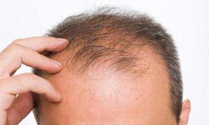 دلیل ریزش موهای آقایان چیست؟