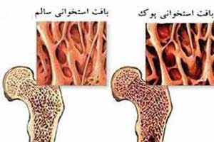 آرایش زیاد باعث پوکی استخوان خانم ها می شود