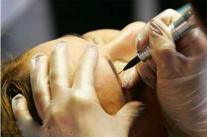 پاک کردن تتو و عوارض پاک کردن خالکوبی و تتو