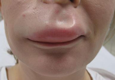 ورم لب | دلیل ورم لب و راه درمان ورم لب چیست؟