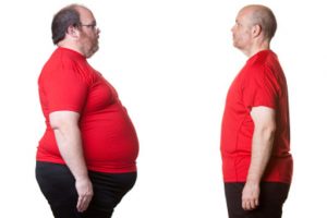 آیا با جراحی کاهش وزن واقعا لاغر می شویم؟ آیا با جراحی کاهش وزن واقعا لاغر می شویم؟