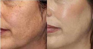 روش های طبیعی برای از بین بردن لکه های سیاه و ترمیم روش های طبیعی برای از بین بردن لکه های سیاه و ترمیم