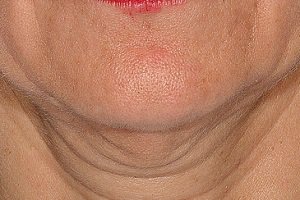 5 راه برای جوان سازی پوست زیر گردن