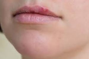 روش پیشگیری از تبخال روش پیشگیری از تبخال