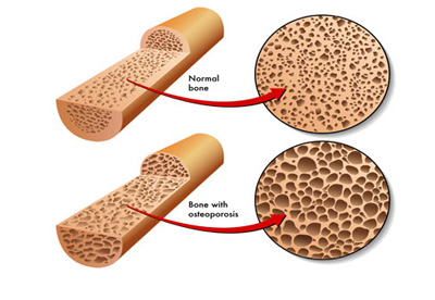 خوراکی هایی که برای استخوان ها ضرر دارند