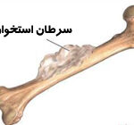 سرطان استخوان | علائم و درمان سرطان استخوان سرطان استخوان | علائم و درمان سرطان استخوان