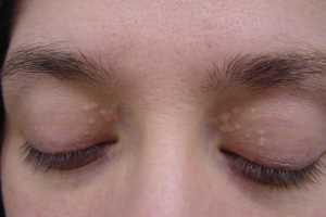 چربی پشت پلک چشم (گزانتالاسما) را چگونه از بین ببریم؟ چربی پشت پلک چشم (گزانتالاسما) را چگونه از بین ببریم؟