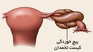 پیچ خوردگی تخمدان چیست و چگونه درمان می شود پیچ خوردگی تخمدان چیست و چگونه درمان می شود