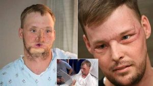پیوند شگفت انگیز صورت به فردی که صورتش نابود شده بود! + تصاویر