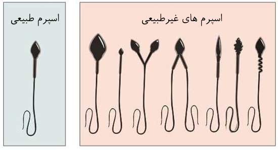 آزمایش اسپرم چیست و چگونه انجام می شود؟ آزمایش اسپرموگرام و آنالیز آن