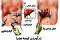 آیا درآوردن کیسه صفرا به دلیل سنگ صفرا عوارض دارد؟