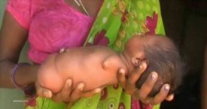 عکس های نوزاد دختری عجیب که دست و پا ندارد! عکس های نوزاد دختری عجیب که دست و پا ندارد!