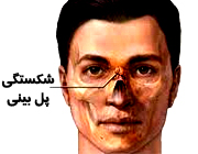 شکستگی بینی بر اثر ضربه و کج شدن بینی