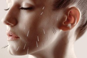 از طب سوزنی برای درمان جوش های صورت استفاده کنید