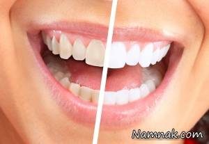 بلیچینگ دندان و انواع روش بلیچینگ دندان بلیچینگ دندان و انواع روش بلیچینگ دندان